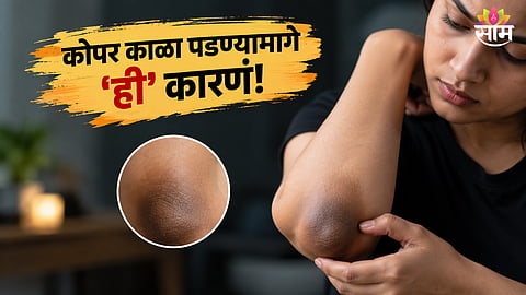 Dark elbows causes