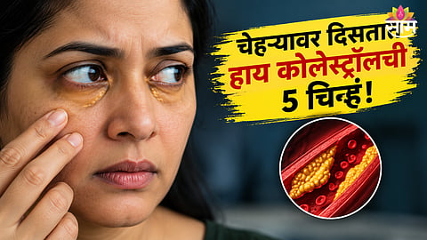 High Cholesterol Symptoms On Face