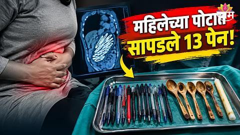 Woman swallows 13 pens