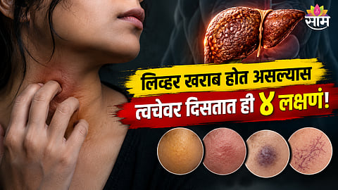 Liver disease symptoms