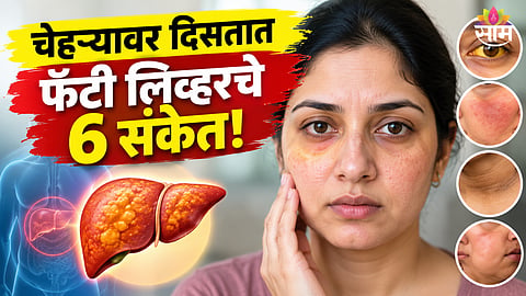 Fatty liver symptoms