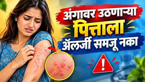 CHRONIC SPONTANEOUS URTICARIA