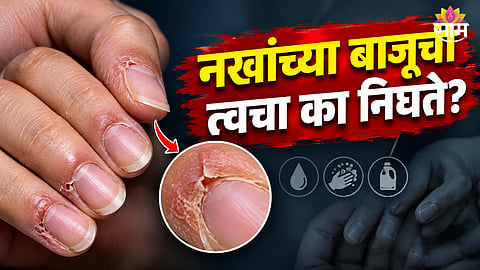 Peeling skin around nails