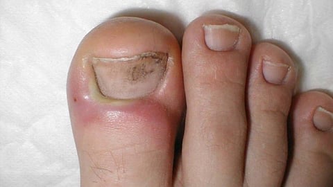 paronychia