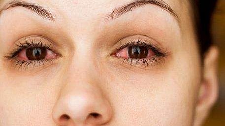 Conjunctivitis 