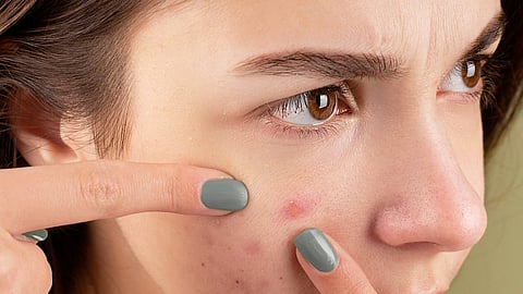 pimples