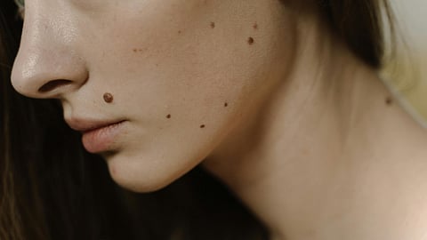 skin mole