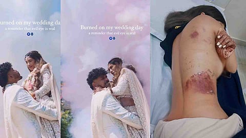 Video: Couple's Photo Shoot Goes Wrong, Colour-Bomb Malfunctions And Burns Bride