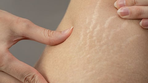 stretch mark