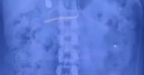Woman arrested in Malappuram for swallowing gold necklace