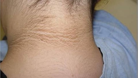 Darkening of Neck