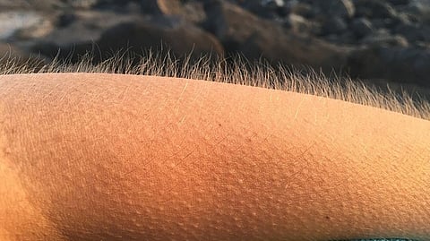 Goosebumps