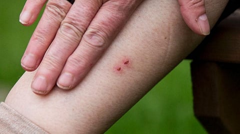 Snake bite