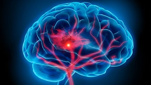 Cerebral Meningitis