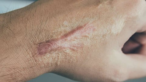 old b urn scar