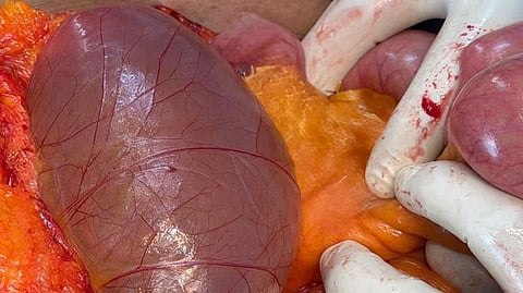 Tumor Removed
