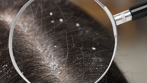 Dandruff in Monsoon