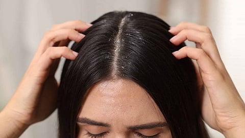 Dandruff in Monsoon