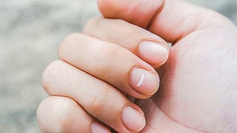 white spot on nails