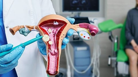 Uterine Fibroids