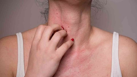 allergy