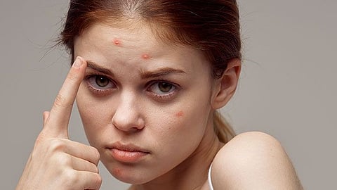 face pimple