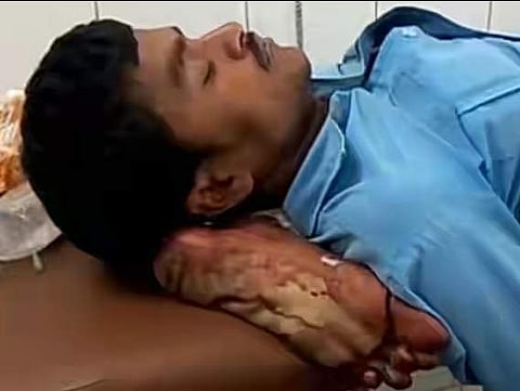 വാഹനാപകടത്തില്‍ കാല്‍ അറ്റുപോയ യുവാവിന് അതേ കാല്‍ തന്നെ തലയണയാക്കി യോഗിയുടെ മെഡിക്കല്‍ കോളേജ്