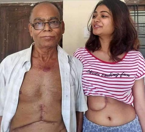 കരളിന്റെ പാതിയിലധികവും അച്ഛന് നല്‍കിയ 19കാരി: പ്രശംസിച്ച് സോഷ്യല്‍മീഡിയ