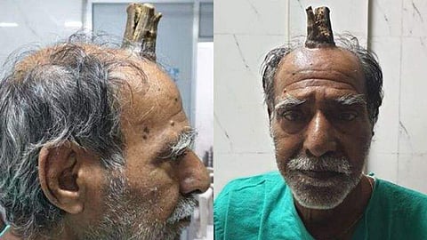 തലയില്‍ 'ചെകുത്താന്‍ കൊമ്പു'മായി 72കാരന്‍; സങ്കീര്‍ണ്ണമായ ശസ്ത്രക്രിയ, രക്ഷപ്പെടല്‍