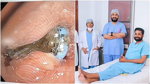 ശ്വാസകോശത്തില്‍ കുരുങ്ങിയ പേനയുടെ നിബ്, സൂരജിനൊപ്പം അമൃത ആശുപത്രിയിലെ ഡോക്ടര്‍മാര്‍/ എക്‌സ്പ്രസ്