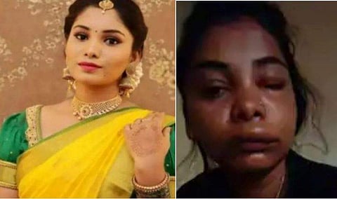 റൂട്ട് കനാൽ ശസ്ത്രക്രിയ പിഴച്ചു, മുഖം നീരുവന്നു വീർത്തു; തിരിച്ചറിയാൻ പോലുമാകാതെ നടി