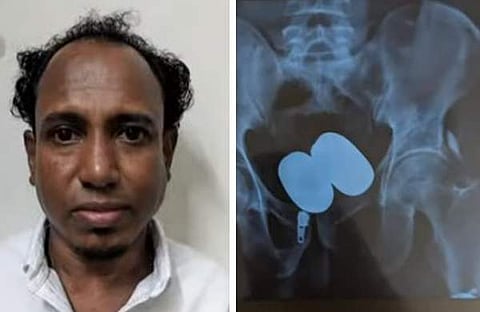 സതീഷ്- ശരീരത്തിനുള്ളില്‍ ക്യാപ്‌സൂള്‍ രൂപത്തില്‍ ഒളിപ്പിച്ച സ്വര്‍ണം