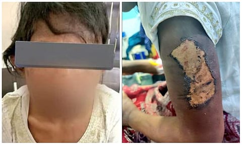ദമ്പതികളുടെ മര്‍ദനത്തില്‍ ക്രൂരമായി പരിക്കേറ്റ 13കാരി