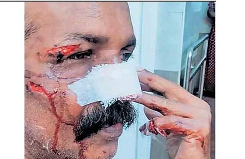 കുറുക്കന്റെ ആക്രമണത്തില്‍ മുഖത്ത് പരിക്കേറ്റ ബേബി