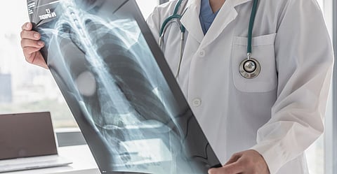 Air pollution a factor for 
lung cancer: SPMC doc
