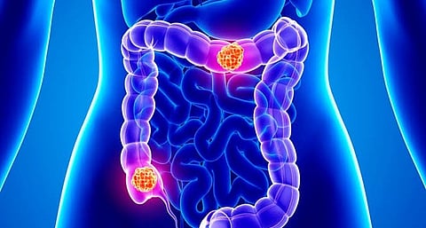 Why is there rise in colon cancer in young people?