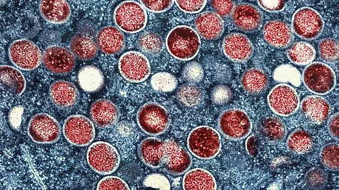 BARMM confirms 2 mpox cases, monitors 6 more  