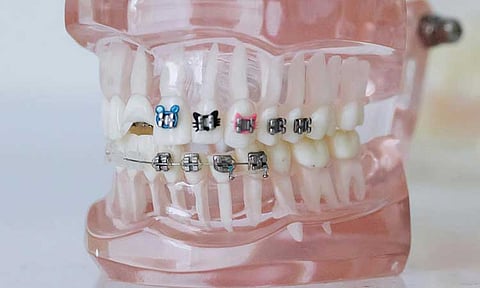#wegotmail: Braces are not fashion accessories