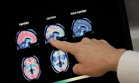 A doctor looks at PET brain scans at Banner Alzheimers Institute in Phoenix on Aug. 14, 2018.