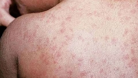 Vaccine hesitancy tests 
measles drive in Mandaue