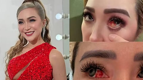 Kitkat suffers eye blood vessel rupture amid extreme heat