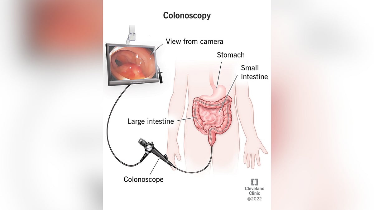 Is colonoscopy required after normal marker result