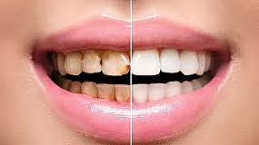 മോണരോഗത്തെ ചിരിച്ചു തള്ളരുത്, ചിരിക്കു വില കൊടുക്കേണ്ടി വരും