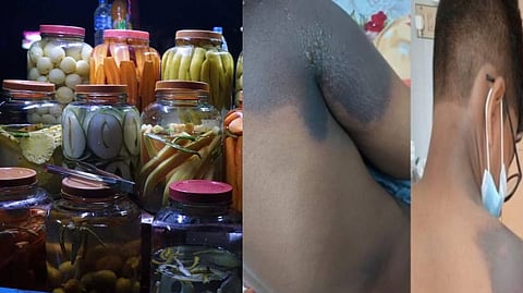 ഉപ്പിലിട്ടത് വില്‍ക്കുന്ന കടയില്‍ നിന്ന് ആസിഡ്‌ കുടിച്ചു; പഠനയാത്രയ്‌ക്കെത്തിയ വിദ്യാര്‍ത്ഥികള്‍ക്ക് പൊള്ളലേറ്റു