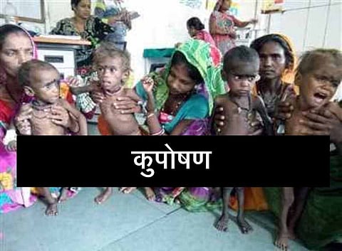 मध्य प्रदेश: 78 हजार से ज्यादा कुपोषित बच्चे, आदिवासी बहुल क्षेत्रों में क्यों बढ़ रहा है कुपोषण?