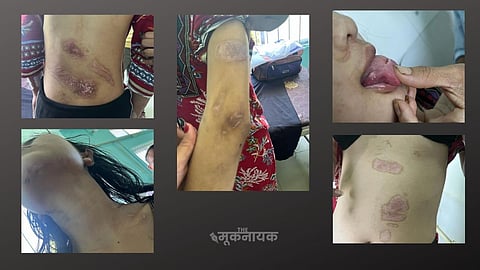 पीड़िता के शरीर पर चोटों के निशान 