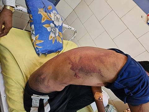 पीड़ित इलाज के लिए मोरबी के सरकारी अस्पताल में भर्ती करवाया गया।