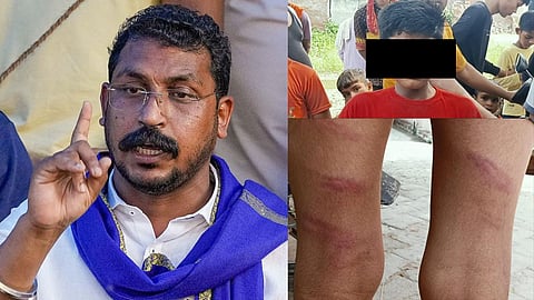 दलित बच्चे को लगी चोटों के निशान 