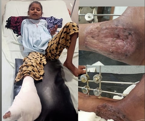 MP: उज्जैन में नौ वर्षीय बच्ची के पैर खराब होने का मामला, बिना रजिस्ट्रेशन के संचालित था क्लीनिक, न्याय के लिए भटक रहा पीड़ित परिवार!