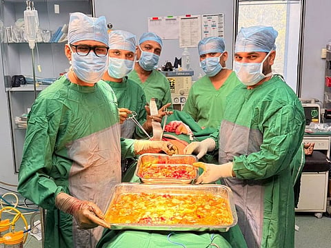 भीलवाड़ा में मरीज के पेट से निकाली गई 500 से अधिक गांठें, लिवर से निकला पाँच किलो से अधिक वजन का हाईडेटिड सिस्ट 